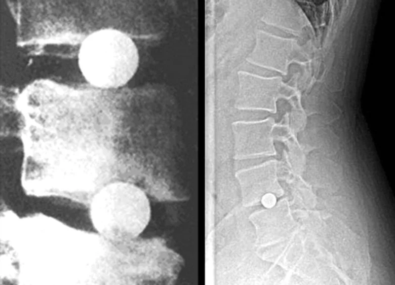 Fernström Ball X-ray showing spherical implant
